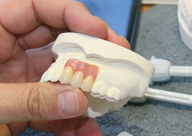 Abb. 7: Auftrag und Individualisierung der Gingiva.