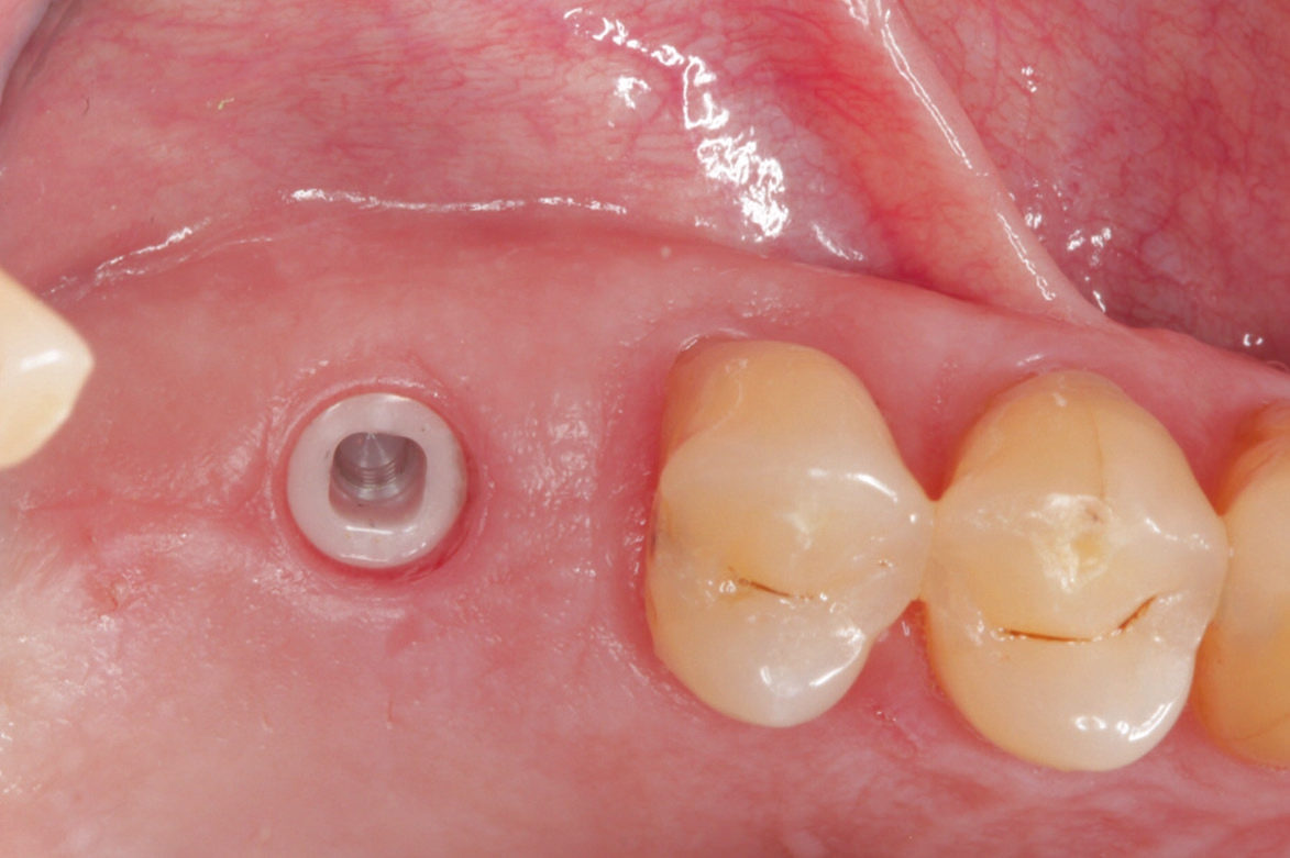 Abb. 8: Gesunde marginale Gingiva.