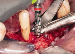 Abb. 7: Aufbereitung des Implantatbettes regio 42.
