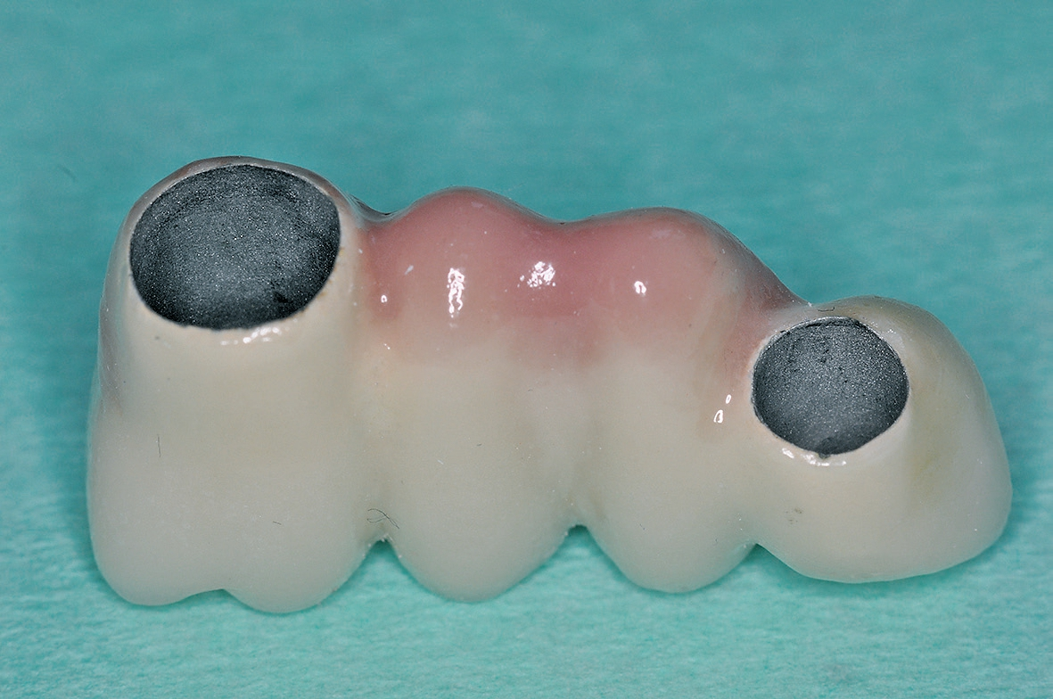 Abb. 8: Ideale Brückengliedgestaltung auf zwei Implantaten.