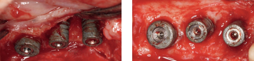 Abb. 9 u. 10: Klinische Darstellung der Phase 2: chirurgische Eröffnung und erneute Dekontamination; Darstellung der chirurgischen Intervention nach starken, periimplantär bedingten Knochenschädigungen an 3 Implantaten im Oberkiefer-Molarenbereich.