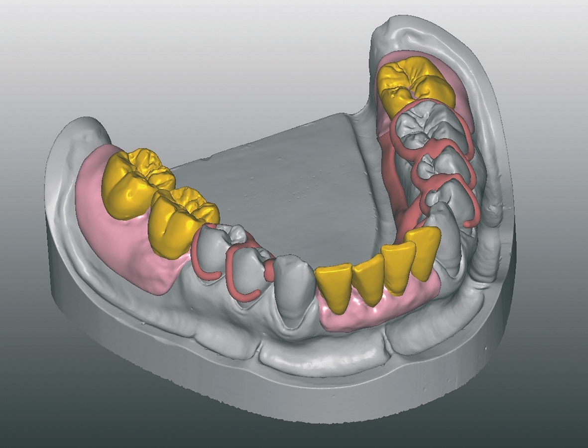 Abb. 8: Gestaltung der Gingiva und Adaption des Zahnfleischsaumes.