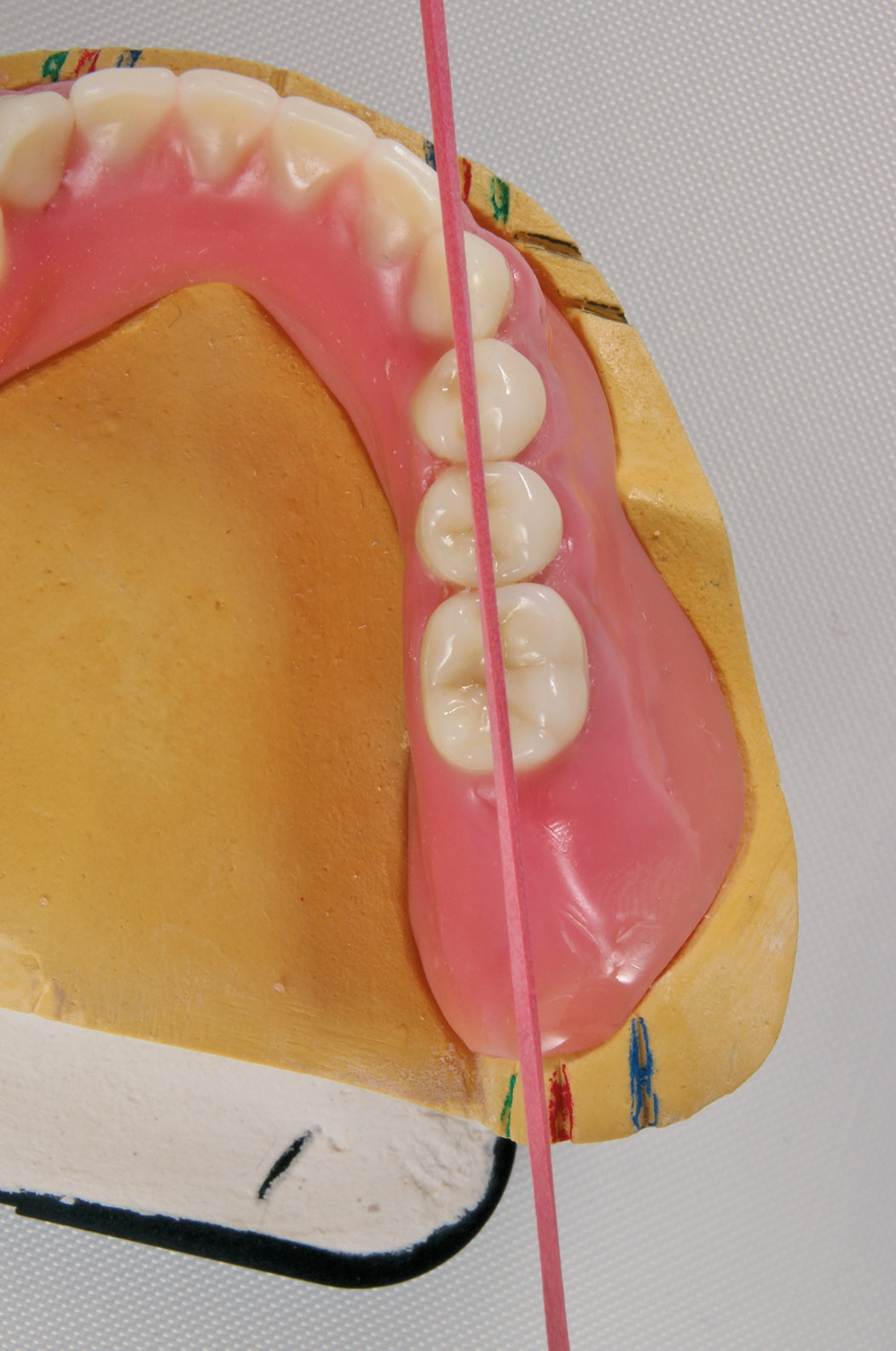 Abb. 7: Okklusale Kontrolle der Aufstellung.