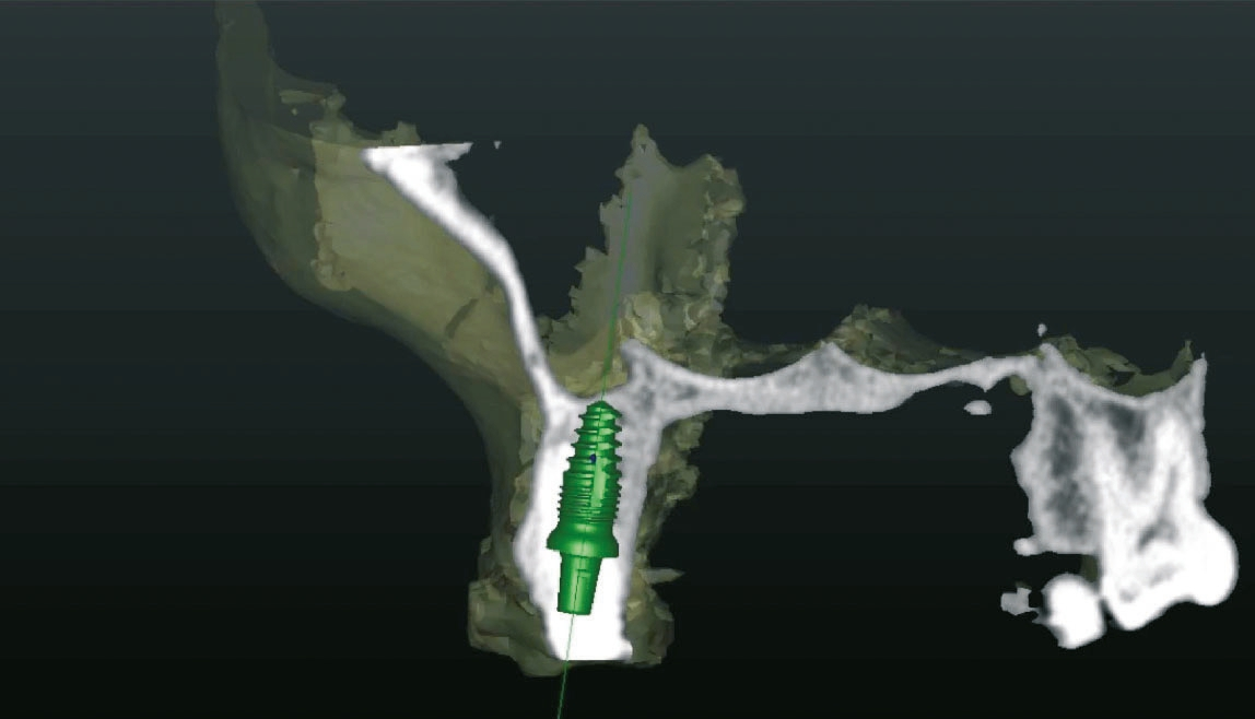 Abb. 7: Blick auf das virtuell gesetzte Implantat in der sagittalen Ansicht.