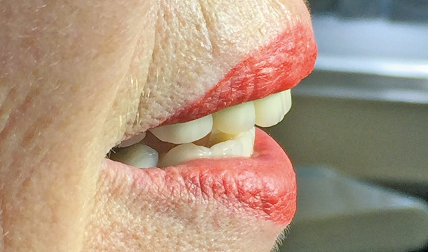Abb. 6: Patientin lächelnd seitlich, leicht negative Lippentreppe.