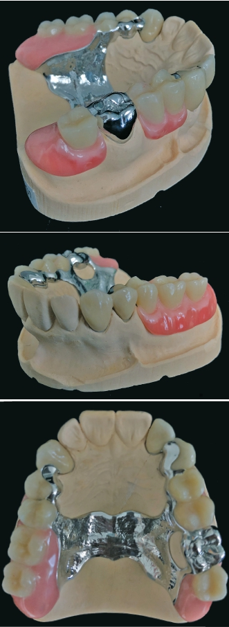 Abb. 9–11: Fertige Oberkieferprothese auf dem Modell.