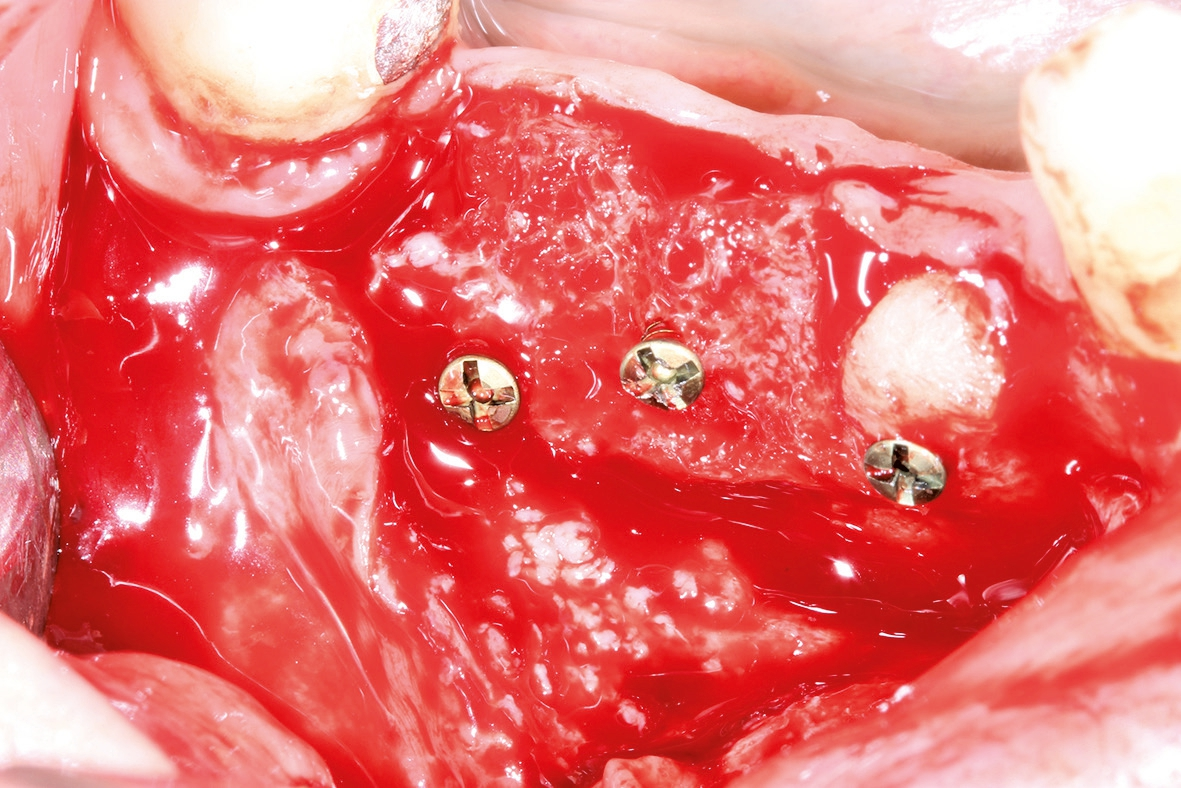 Abb. 8: Lage- und rotationsstabile Fixierung der allogenen Knochenblöcke auf dem Empfängerbett mit Osteosyntheseschrauben.