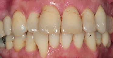 Abb. 4: Intraorale Aufnahme der Front vom 12.06.2019: lokalisierte Rötung und Schwellung der marginalen Gingiva. In der Unterkieferfront ist interdentaler Zahnstein erkennbar.