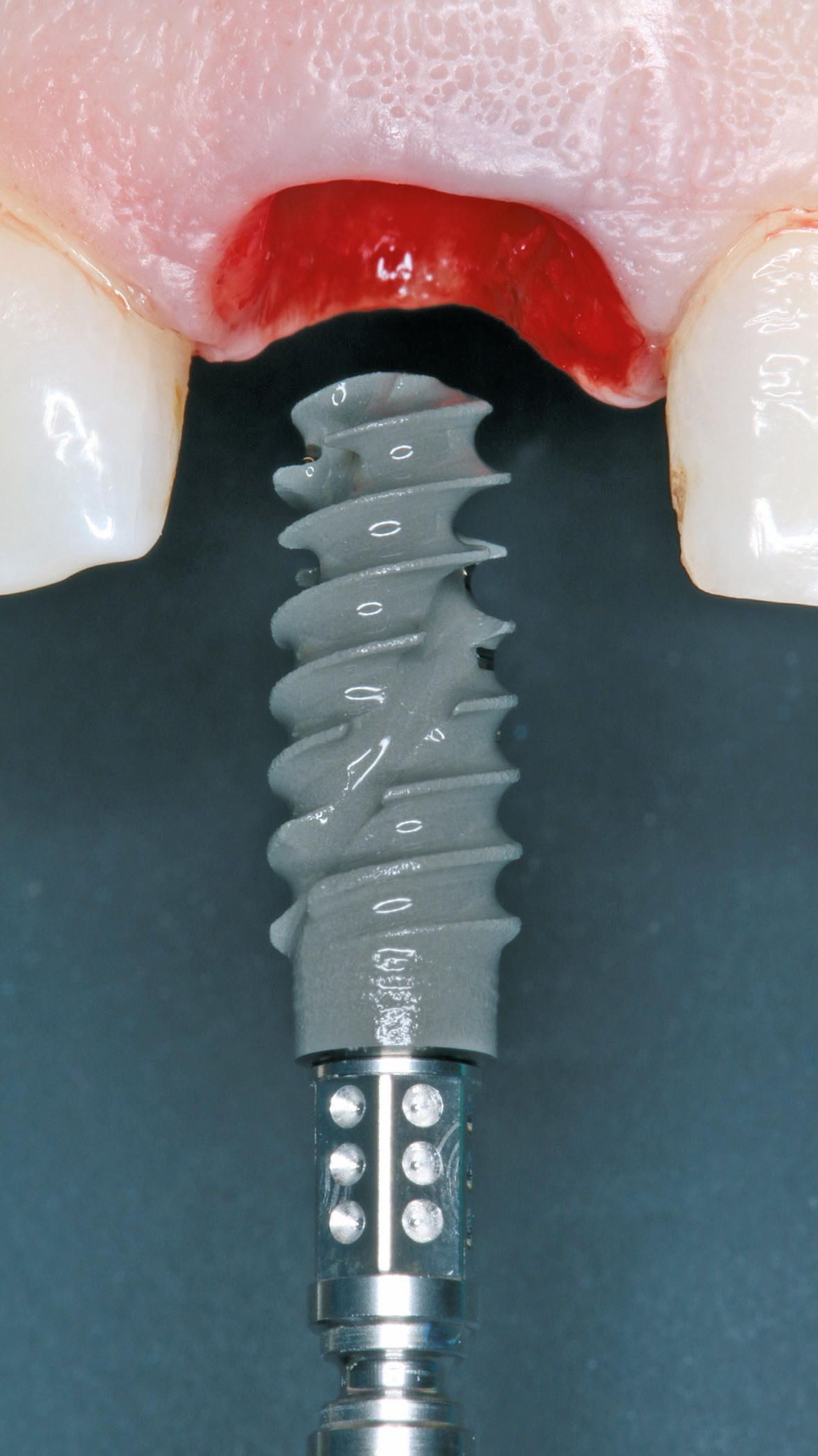 Abb. 6: Einsetzen des Implantates (Straumann BLX, Ø 3,75mm, L: 10mm).