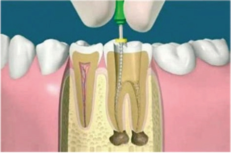Abb. 15: Die sagittal ausgerichtete CNIP-Navigation begleitet die Champions-Guides!