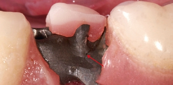 Abb. 8: Gerüstfraktur am Extensionsglied bei festsitzenden, rein implantatgetragenen Suprastrukturen im Ober- und Unterkiefer, 2 Jahre nach Eingliederung. Es lagen weitere Frakturen vor. Neben hohen okklusalen Kräften kommt hier eine Unterdimensionierung als Frakturursache infrage.