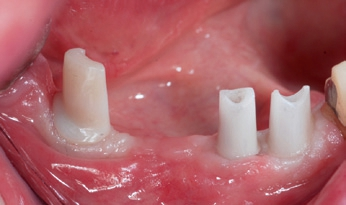Abb. 8: Zirkonoxid-Abutments individuell auf Klebebasen.