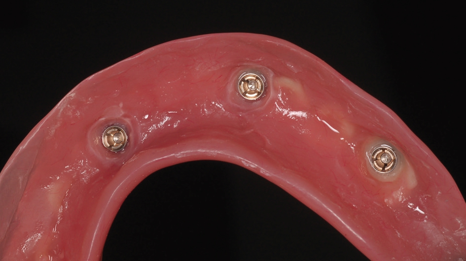 Abb. 9: In die Prothesenbasis eingearbeitete Matrizen für die Kugelkopfanker.