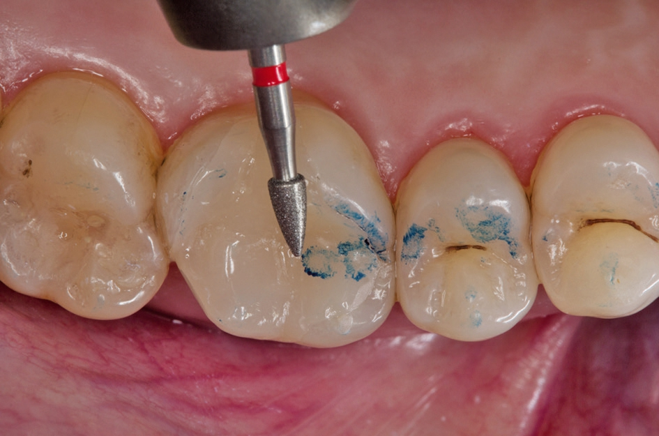 Abb. 8: Cerec-gefertigtes Onlay aus zirkonverstärktem Lithiumsilikat (Celtra Duo) bei der okklusalen Adjustierung.