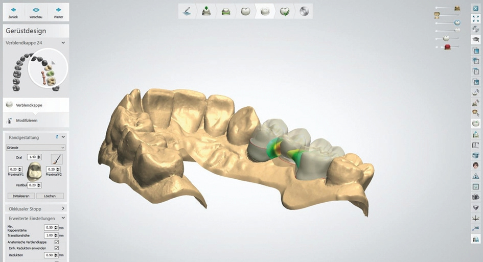 Abb. 8: Das anatomische Design hilft wesentlich, das Chipping-Risiko zu minimieren.