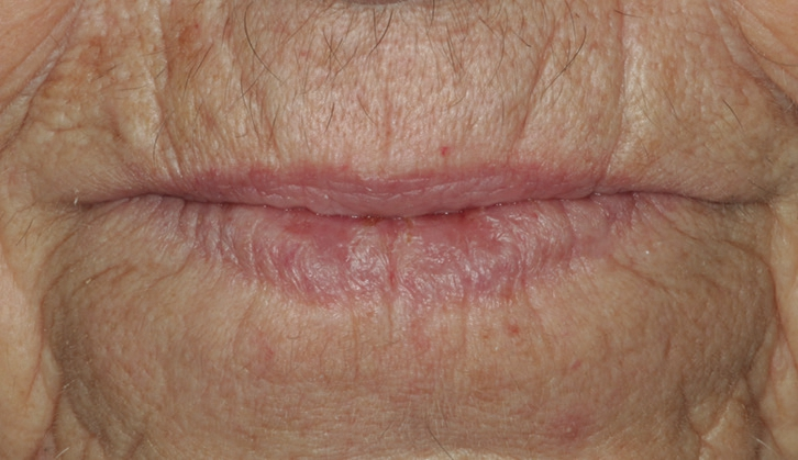 Abb. 9: Das neue Lippenbild gefällt der Patientin besser als das alte, es wirkt natürlicher.