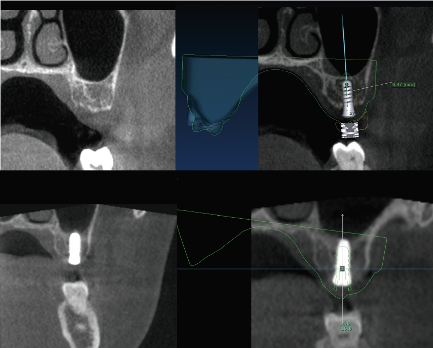 Abb. 6: Ausschnitte eines digitalen Workflows einer navigierten Implantation in regio 27 mit internem Sinuslift samt postoperativer Ergebniskontrolle der Implantatachse. (KaVo OP300 Maxio, präoperativ im Standard Modus, postoperativ im Low-Dose-Modus, jeweils FOV Ø 15 x 8 cm).
