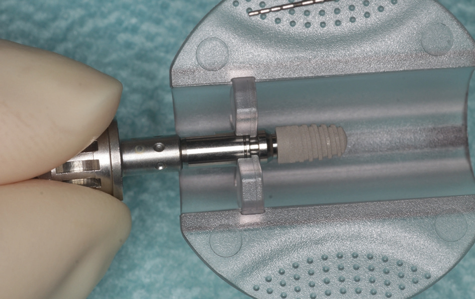 Abb. 8: Ankylos-Implantat der Länge 6,6 mm.