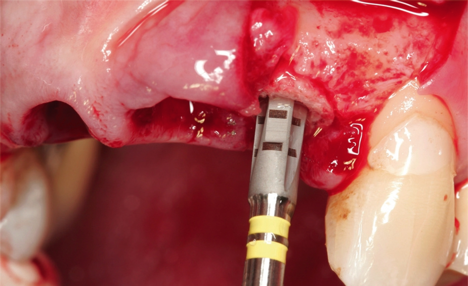 Abb. 7: Implantation maxgraft® bonering 6 mm und Implantatvorbereitung durch den Ring.