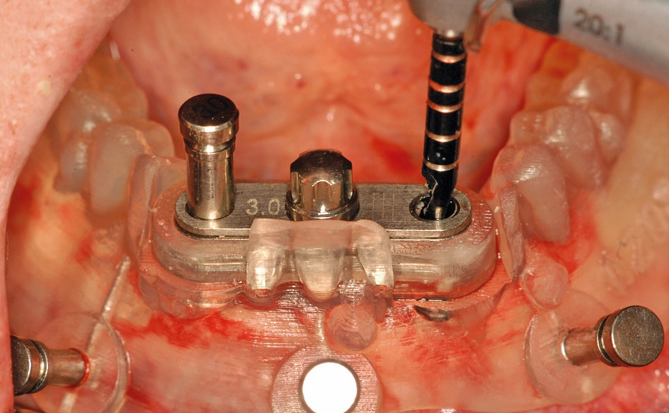 Abb. 8: Die Präparation des Implantatbettes wird durch die Doppelbohrhülse durchgeführt, die zusätzlich mit einem vertikalen Pin auf dem Kiefer stabilisiert wird.