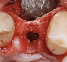 Abb. 8: Das Implantatlager wurde innerhalb der Osteotomie mit einem Gemisch aus autologen Knochenspänen und Bio-Oss Collagen gefüllt.