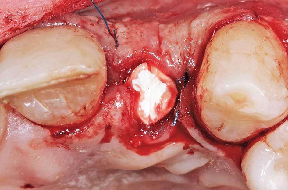 Abb. 8: Der gingivale Defektbereich wurde mit einem Kollagenkegel verschlossen.
