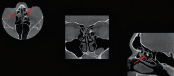 Abb. 11: Osteom im Sinus ethmoidalis.