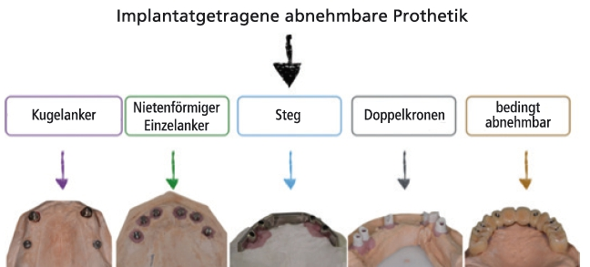 Abb. 8: Beispiele für Verankerungen.