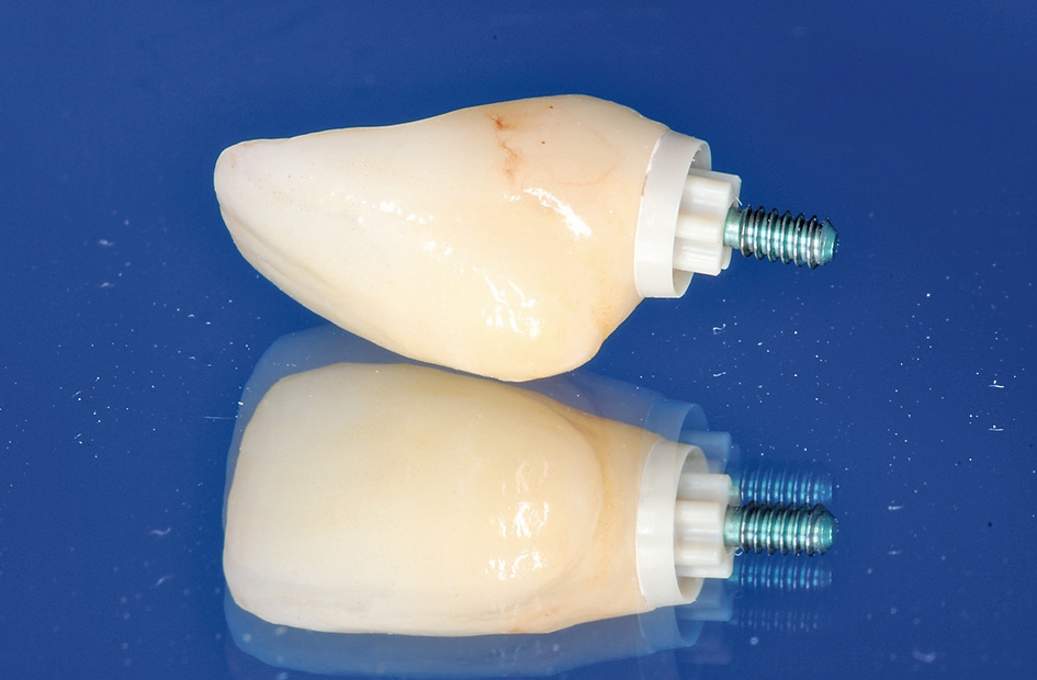 Abb. 23: Nach der Einprobe wurde das PEKK-Abutment silanisiert, die Krone geätzt, und die einzelnen Komponenten wurden mit einem Hybridabutmentkleber definitiv verbunden.