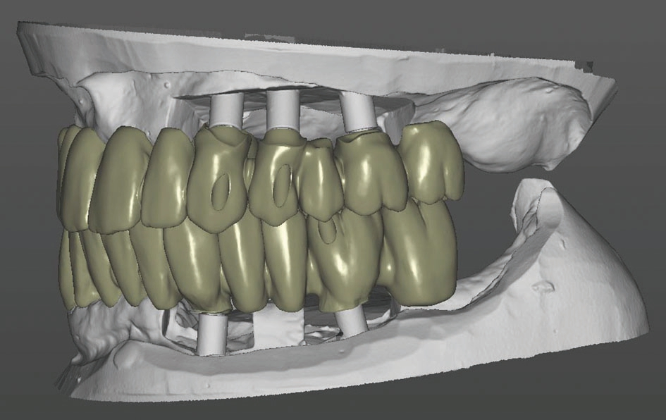 Abb. 17: In der Software gestaltete Ästhetik-Anprobe mit Klebebasen für die Abutments.
