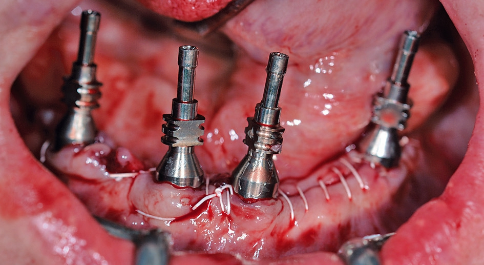 Abb. 10: Auf den defi nitiven Abutments aufgeschraubte Abformpfosten (offene Abformung).