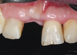 Abb. 9: Reizfrei abgeheilte periimplantäre Mukosa (4 Monate post op).