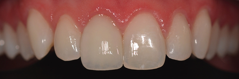 Abb. 12: Definitive Krone auf individuellem Abutment mit harmonischem Gingivaverlauf und natürlich anmutender Zahnform und -farbe.