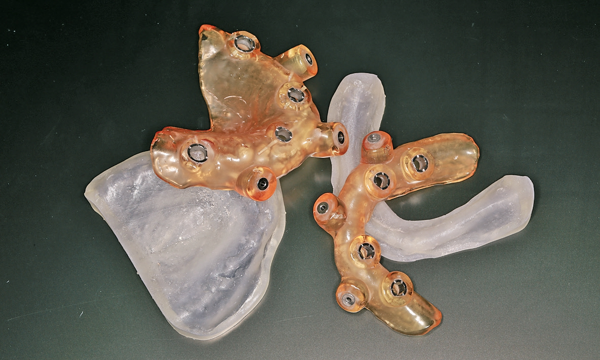 Abb. 8: Die Schablonen wurden nach Vorgabe der Planung geliefert. Die Modelle wurden gedruckt.