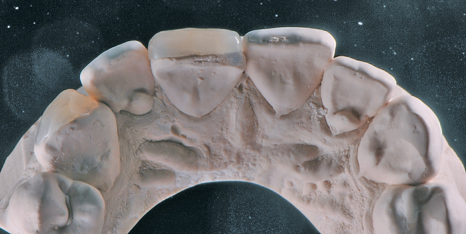 Abb. 9: Die fertigen Veneers auf dem Modell von inzisaler Ansicht.