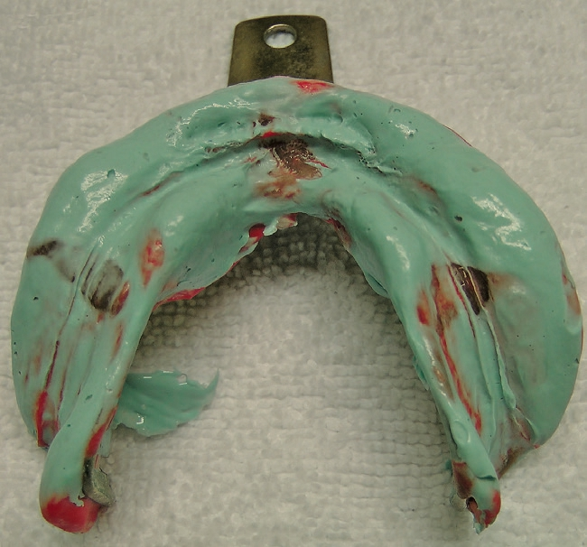 Abb. 4a: Anatomische Abformung des Unterkiefers.