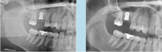 Abb. 14 u. 15: Minimales Aufwandern von Zahn 17 zum Implantat aufgrund des nicht getragenen Interimsersatzes.