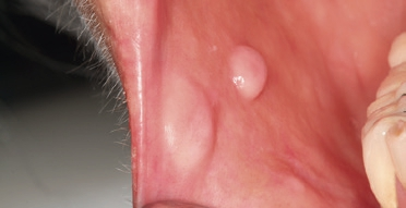 Abb. 8: Zwei glatt begrenzte exophytische Neubildungen, Mundwinkel rechts, Planum buccale rechts. Palpationsbefund: schmerzlos und weich.