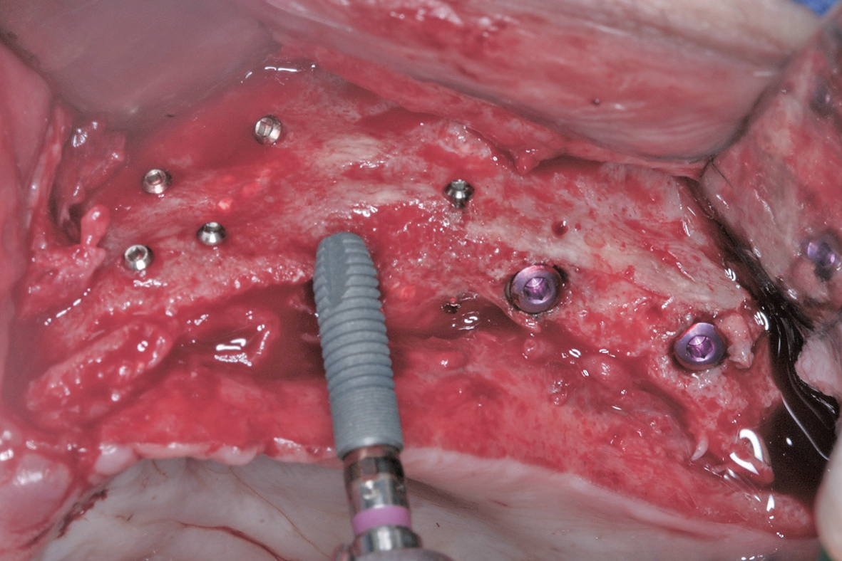 Abb. 7: In den neu aufgebauten Knochen können 6 Astratech Implantate (Dentsply Sirona) inseriert werden.