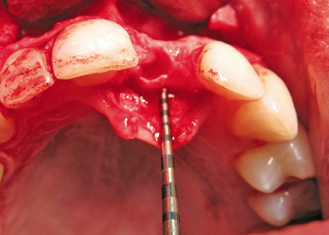 Abb. 6: Um einem Knochenabbau der vestibulären Knochenlamelle vorzubeugen, wählte der Operateur eine palatinale Position des Implantates.