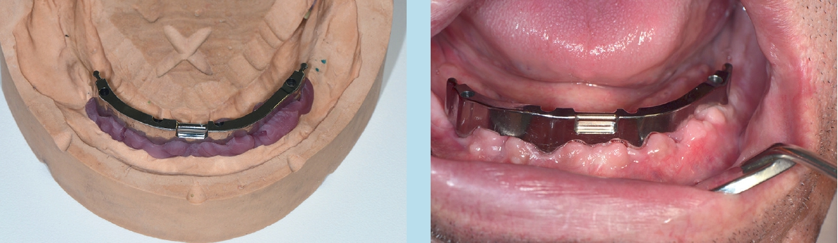 Abb. 5 u. 6: Modellsituation und eingegliederter gefräster Steg auf 4 Implantaten mit dorsalen Extensionen.