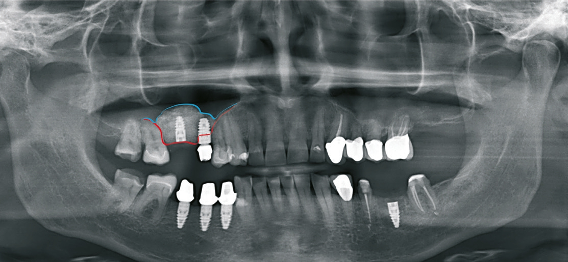 Abb. 8: OPG nach Implantation in regio 16 und 36.