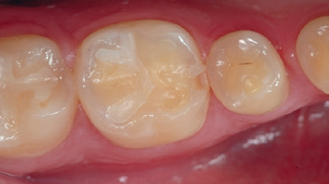 Abb. 8: Eindeutige erosive Schäden an einem unteren Molaren und Prämolaren. Die Komposit-Füllungen erscheinen leicht „angehoben“. Die Kelche oder Dellen im mesiobukkalen Höcker des Molaren und bukkalen Höcker des Prämolaren geben Anlass zu intensiven zahnmedizinischen Gegenmaßnahmen, insbesondere präventiver Natur.