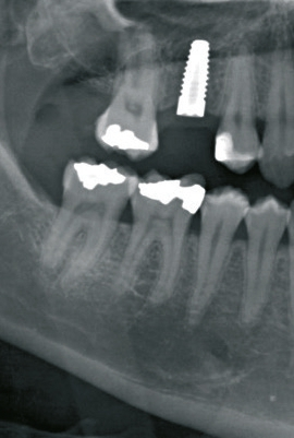Postoperative Kontroll-OPTG des Keramikimplantates nach Summers-Osteotomie unterstützter Empfängerbett- und Gewinde-Präparation mit 45 Ncm Primärstabilität.