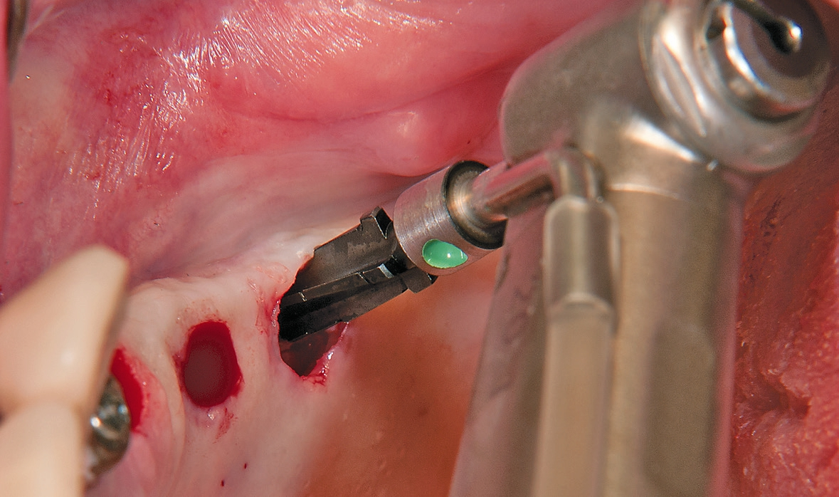 Abb. 8: Nach Ankörnen und Pilotbohrung, Ausformen der Implantatalveole mit ZERADRILL.