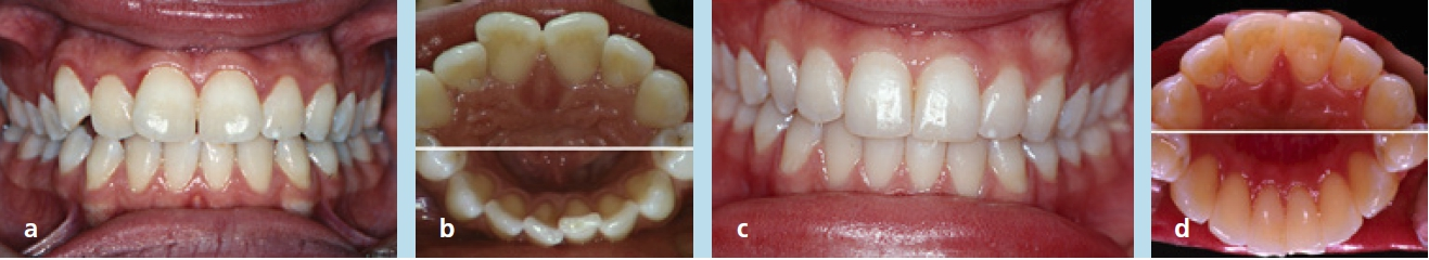 Abb. 7a–d: Situation einer Patientin mit Engstand in beiden Kiefern (a u. b), der durch Schmelzreduktion aufgelöst wurde (c und d).