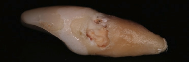 Abb. 7: Die Resorption von 21 extern. Die Richtigkeit der Diagnose durch das bildgebende Verfahren wurde hier bestätigt.