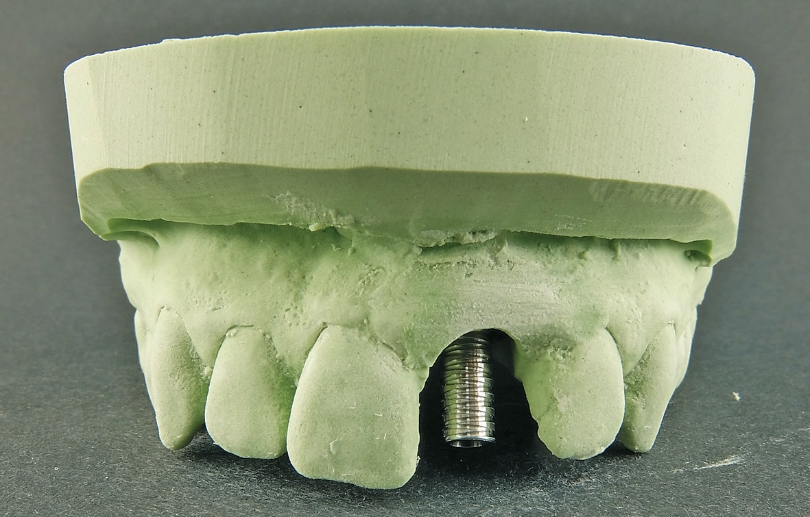 Abb. 17: Das Titan-Abutment als Gerüst für die provisorische Krone.