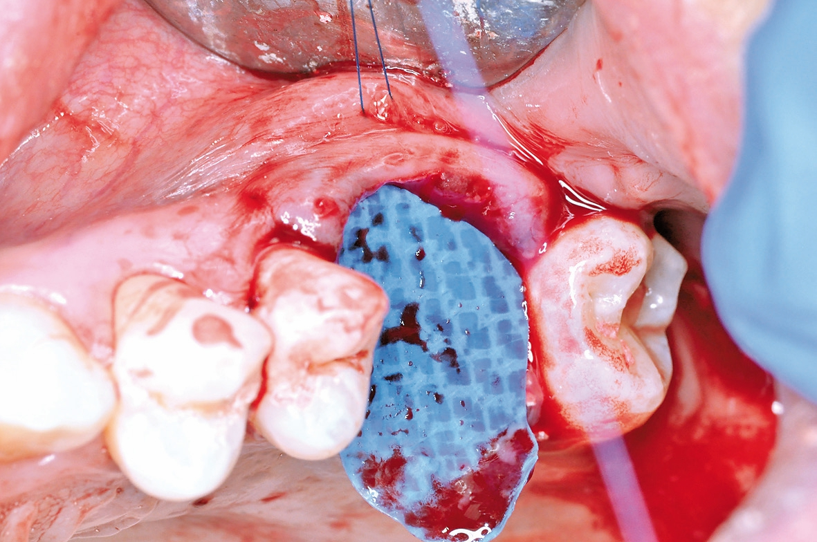 Abb. 8: Insertion der zugeschnittenen nicht-resorbierbaren Membran (permamem®, botiss biomaterials, Zossen, Deutschland) in zuvor präparierte Weichgewebetaschen.
