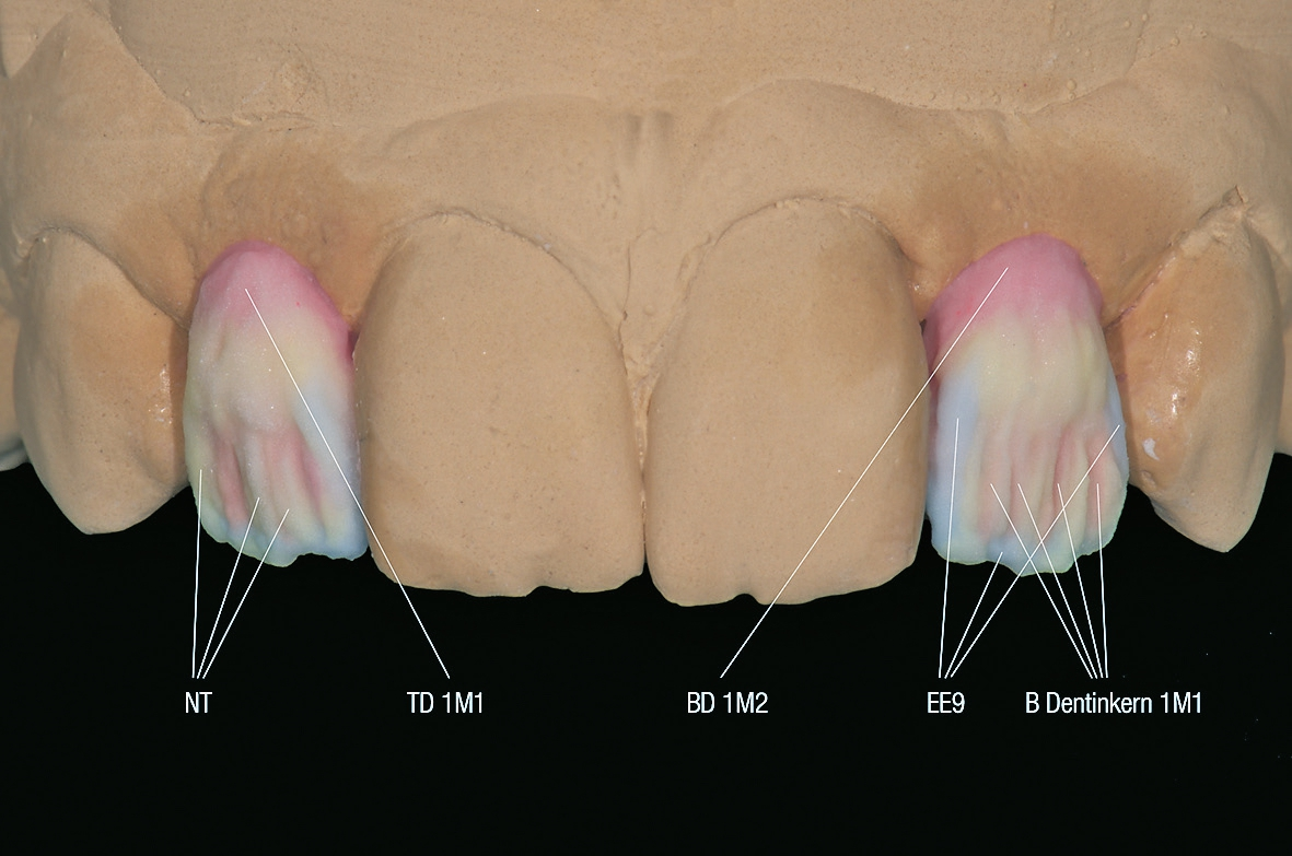 Abb. 8: Auftrag der ersten Schicht vor dem ersten Dentinbrand.